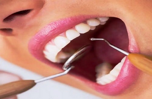 خطرات اصلی لمینت دندان چیست